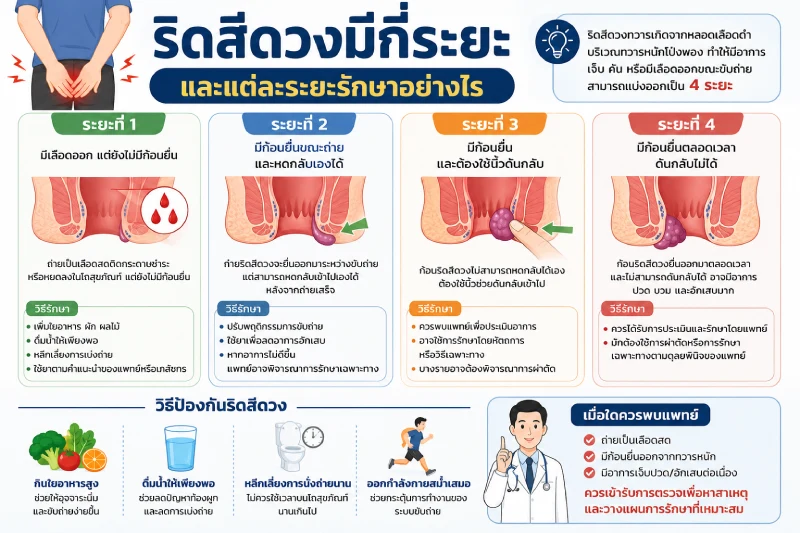 ริดสีดวงมีกี่ระยะ และแต่ละระยะรักษาอย่างไร