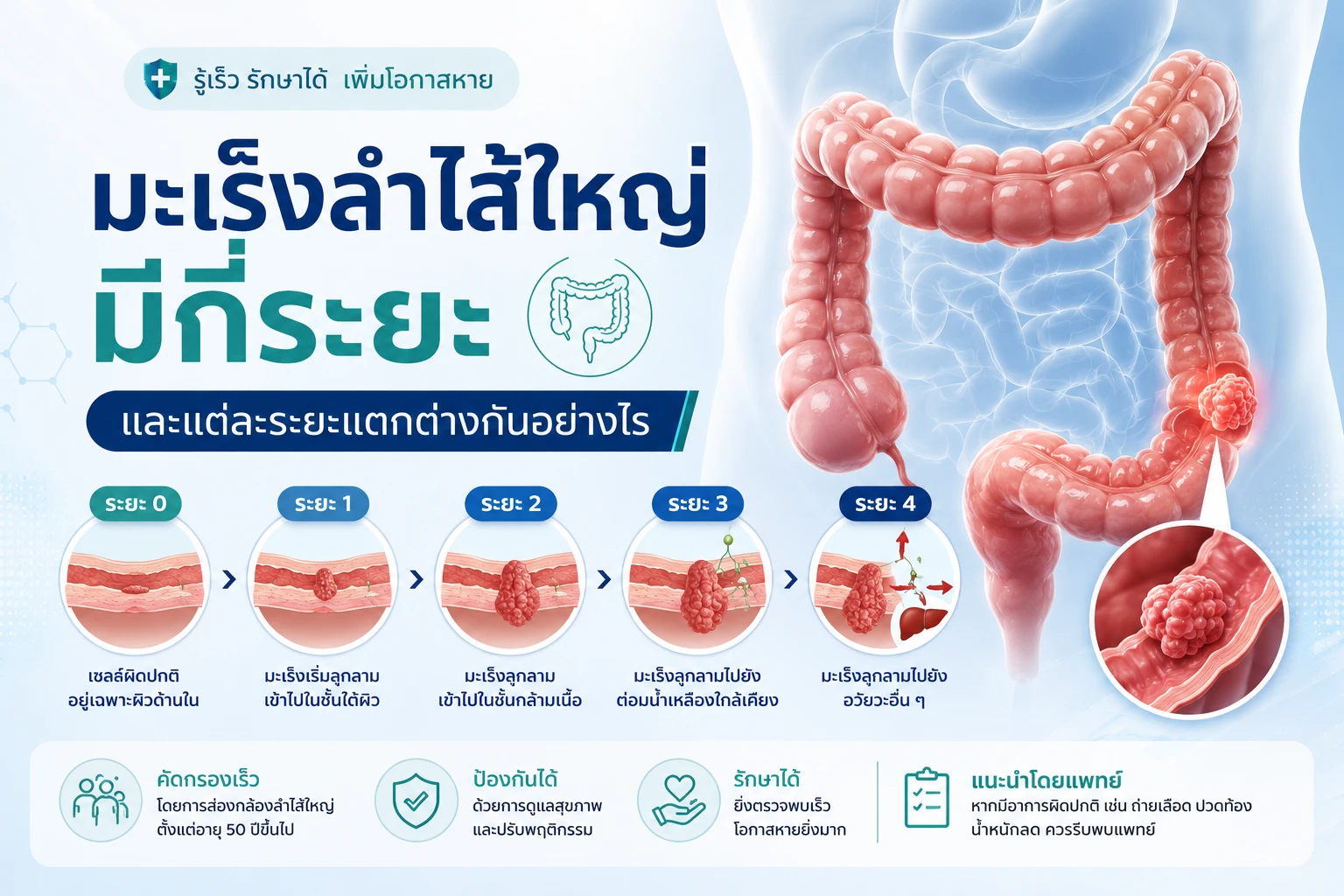 มะเร็งลำไส้ใหญ่มีกี่ระยะ และแต่ละระยะแตกต่างกันอย่างไร